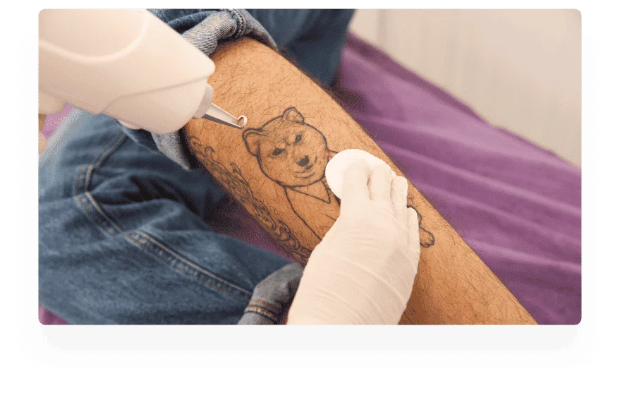 Détatouage jambe Détatouage jambe