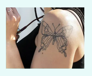 Détatouage tatouage noir