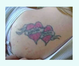Tatouage accidentel